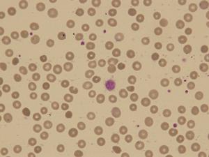 捐獻血小板會對身體產生哪些負面影響