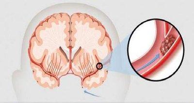 腦梗塞一旦出現應該如何按摩頭部