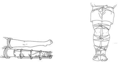 做一個小腿骨折的手術需要多長時間