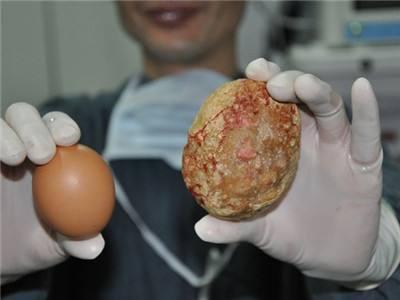 尿路結石是吃進的小石子？