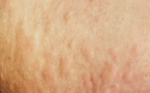 全身性濕疹出現(xiàn)的原因以及如何根治