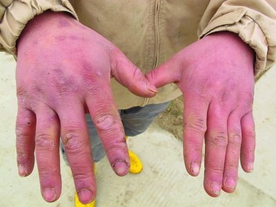 冬天天氣寒冷手部經常皴裂怎么辦