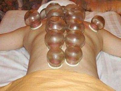 拔火罐的頻率控制在幾天拔一次最好