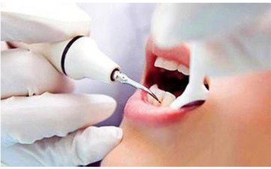 洗牙通常來說需要多長時間洗干凈