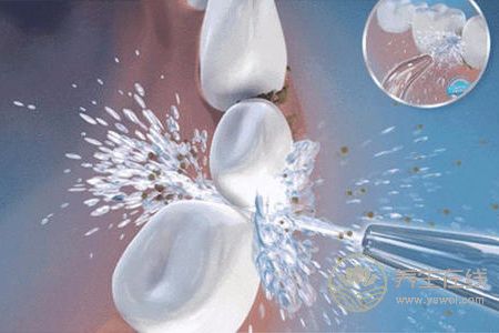 洗牙有什么好處?洗牙后注意事項有哪些?