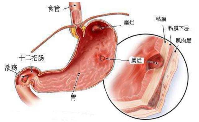 消化性潰瘍分為哪些不同的類型會有哪些表現-易網健康<a href=http://www.gyfww.com/jkys/ target=_blank class=infotextkey>養生</a>網 消化性潰瘍分為哪些不同的類型會有哪些表現