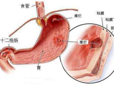 消化性潰瘍分為哪些不同的類型會有哪些表現