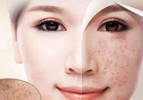 導致臉上長斑的原因以及有哪些能祛斑的中藥