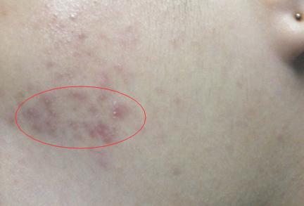 想要去除痘印有哪些比較好的方法