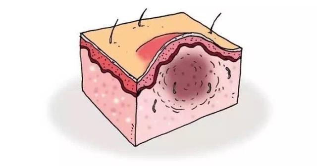 毛囊炎反復發作的原因以及治療方法