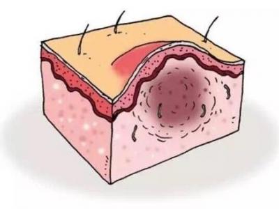 毛囊炎反復發(fā)作的原因以及治療方法