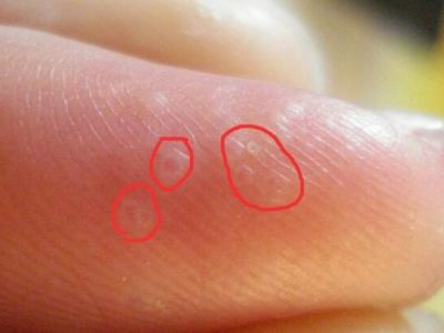 腳上的泡應該怎么處理腳上出泡怎么辦