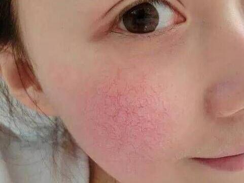 紅血絲形成的原因如何去除紅血絲