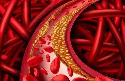 血管堵塞會導致很多疾病的出現如何清理血管呢