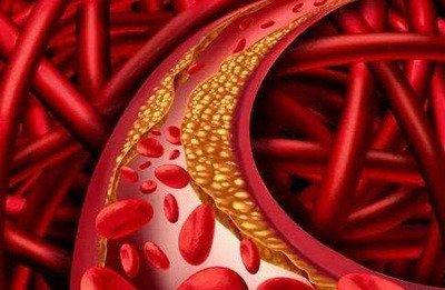 血管堵塞會(huì)導(dǎo)致很多疾病的出現(xiàn)如何清理血管呢