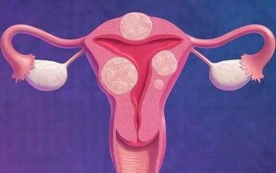 這七類女性是子宮肌瘤的高發(fā)人群-易網(wǎng)健康<a href=http://www.gyfww.com/jkys/ target=_blank class=infotextkey>養(yǎng)生</a>網(wǎng) 這七類女性是子宮肌瘤的高發(fā)人群