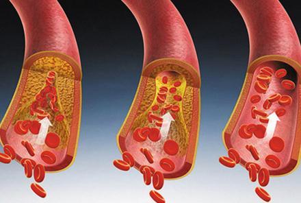 如果你的身上這兩處疼痛八成是血脂高了-易網健康<a href=http://www.gyfww.com/jkys/ target=_blank class=infotextkey>養生</a>網 如果你的身上這兩處疼痛八成是血脂高了