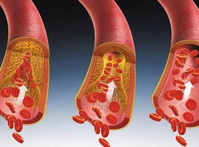 如果你的身上這兩處疼痛八成是血脂高了