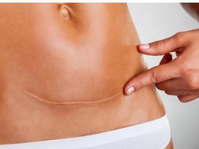 孕婦在生產(chǎn)過程中什么情況可以進(jìn)行剖腹產(chǎn)手術(shù)