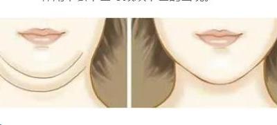 為什么會(huì)長(zhǎng)雙下巴的幾種原因