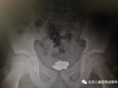 大夫，寶寶把東西塞進下面了！怎么辦？