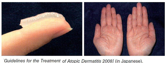 患特應(yīng)性皮炎的人，如何“迎戰(zhàn)”秋燥？