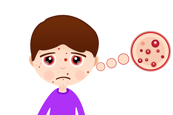 額頭長(zhǎng)痘痘是什么緣故