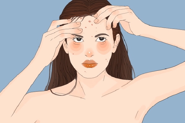 上火長痘痘怎么調理去火 上火冒痘吃什么降火