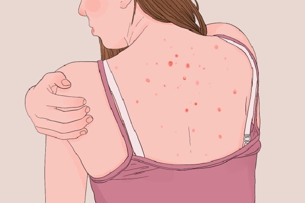 怎么判斷自己濕氣重不重 人體內濕氣重如何解決