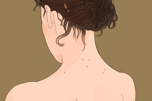 上火長痘痘怎么調理去火 上火冒痘吃什么降火