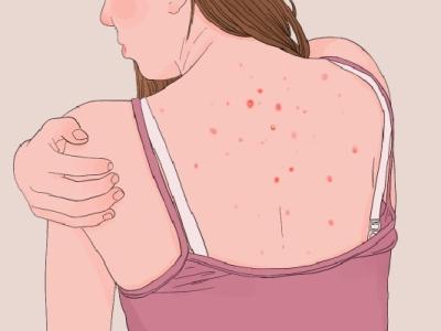 怎么判斷自己濕氣重不重 人體內(nèi)濕氣重如何解決