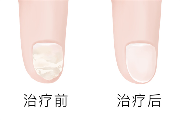 治療灰指甲哪家醫院好