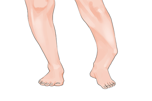 先天性馬蹄內(nèi)翻足表現(xiàn)