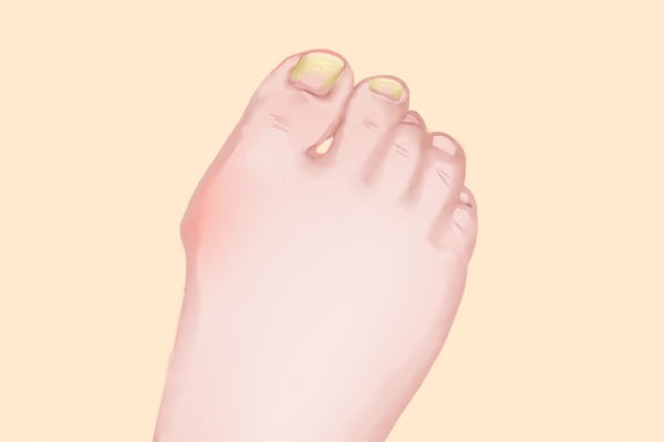 治療灰指甲哪家醫院好