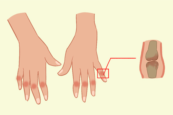 痛風能不能吃辣條