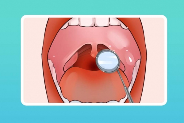 扁桃體炎是什么癥狀