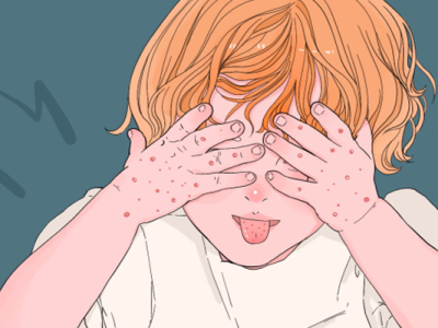 絲蟲(chóng)病分類有哪些?