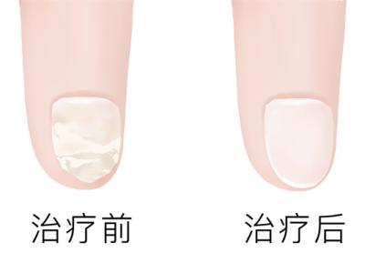 治療灰指甲哪家醫院好