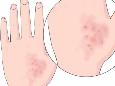 水痘能不能吃荷蘭豆