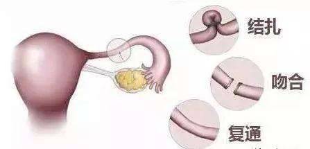 女性結扎會不會影響夫妻性生活，到底結扎對女人有什么危害