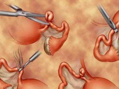 二胎剖腹產(chǎn)后做結(jié)扎手術(shù) 結(jié)扎對(duì)女性身體影響有多大