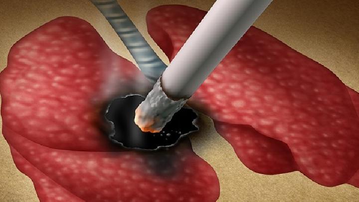 肺癌患者可以過性生活嗎？你知道為什么肺癌不傳染嗎？