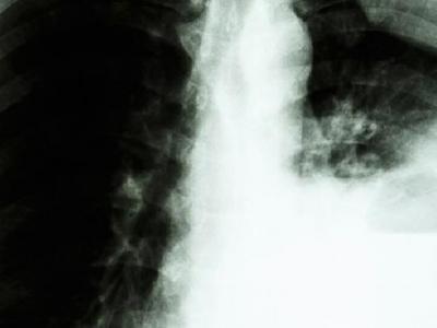 肺癌患者可以過性生活嗎？你知道為什么肺癌不傳染嗎？