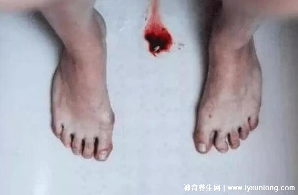 真實女生內膜破壞的圖片，剝脫的子宮內膜伴隨經血排出