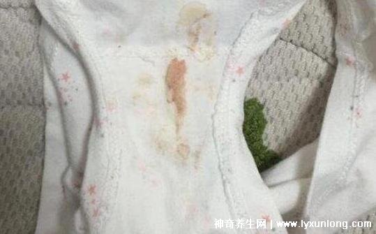 宮頸癌褐色分泌物圖片，少量不規(guī)則出血伴隨X交痛(腥臭分泌物)