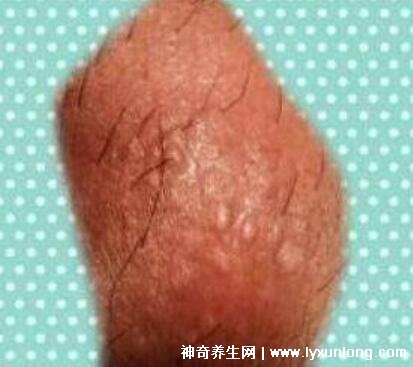 初期尖銳濕尤圖癥狀圖片男性,淡紅色小疙瘩變大為菜花狀疣體-易網(wǎng)健康養(yǎng)生網(wǎng) 初期尖銳濕尤圖癥狀圖片男性,淡紅色小疙瘩變大為菜花狀疣體