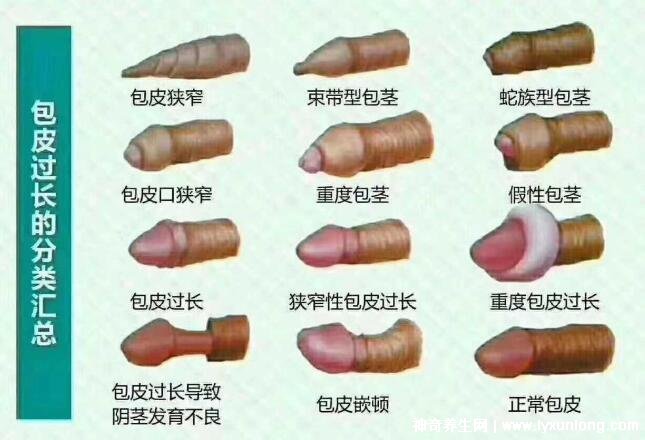 老公割包之后好像沒有那么厲害了，因為更敏感了(5個原因)