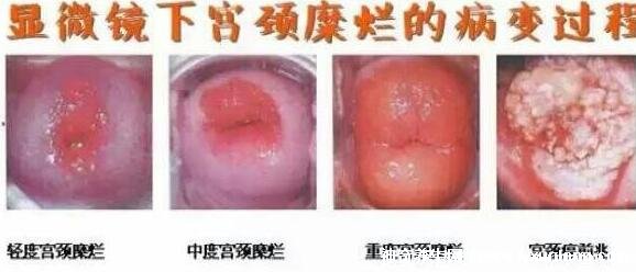 宮頸糜爛一二三度圖片，真實對比照片(小心是宮頸癌前兆)