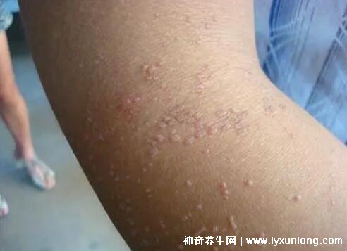 男性疣是什么樣子圖片，尖銳濕疣/扁平疣/絲狀疣發(fā)病部位不同