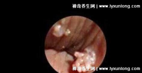 初期尖銳濕尤圖癥狀圖片男性,淡紅色小疙瘩變大為菜花狀疣體-易網(wǎng)健康養(yǎng)生網(wǎng) 初期尖銳濕尤圖癥狀圖片男性,淡紅色小疙瘩變大為菜花狀疣體